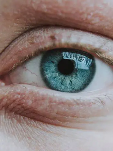Eye lid and eye bag before undergoing treatment