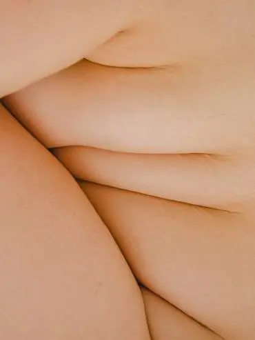 Rolls of fat on woman's body before getting fat dissolving injections.