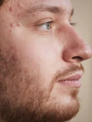Male with acne on face has Roaccutane treatment in Bury.