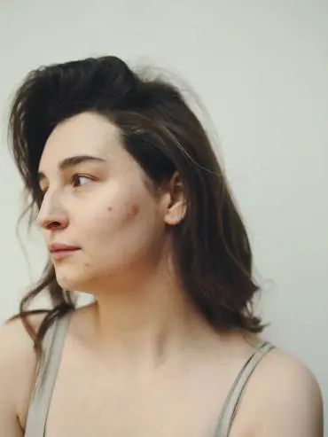 Young lady with acne on face