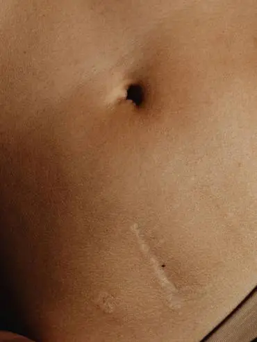 Scar on stomach, about to go under micro-needling treatment