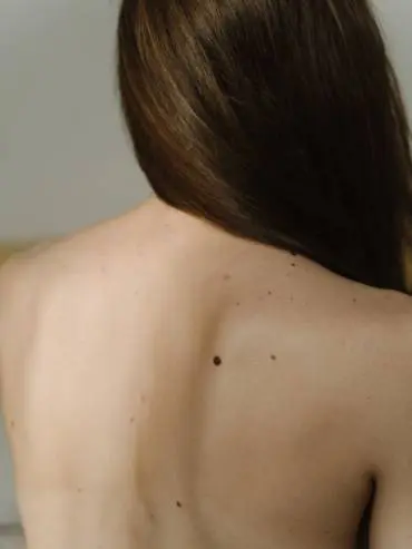 Woman with moles on back. Skin cancer screening in Bury, Lancashire.