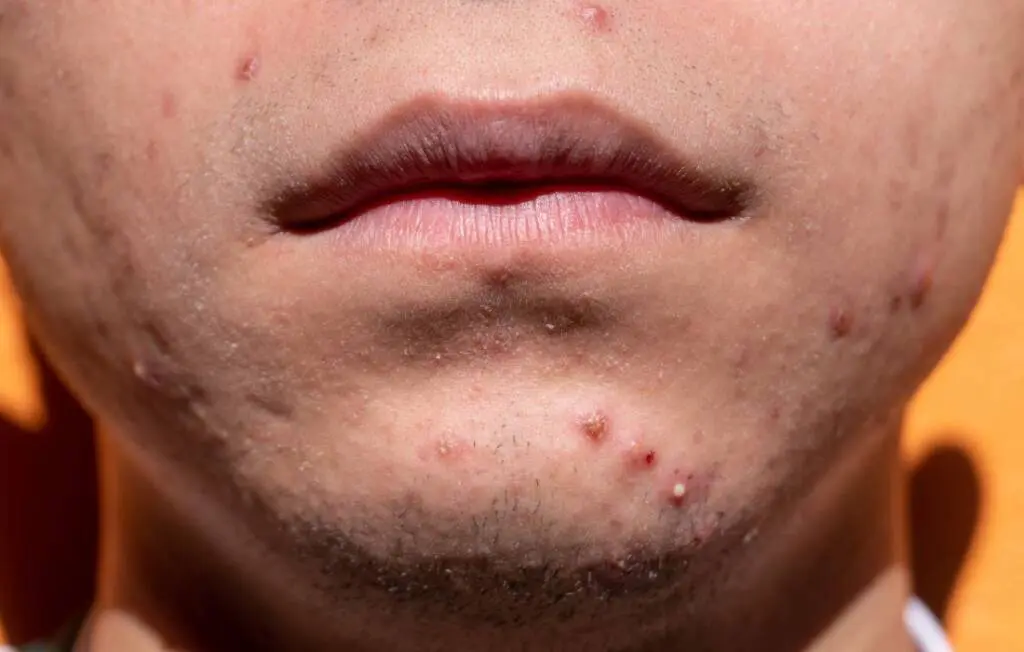 Lower part of a man's face covered with acne