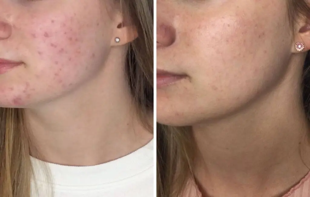 Woman's face before and after acne treatment