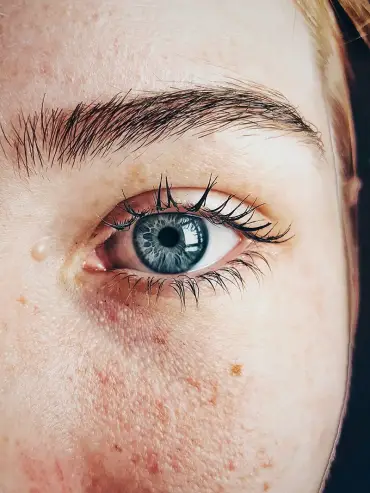 Woman with skin lesion on face, about to get it removed at Blemish Clinic.