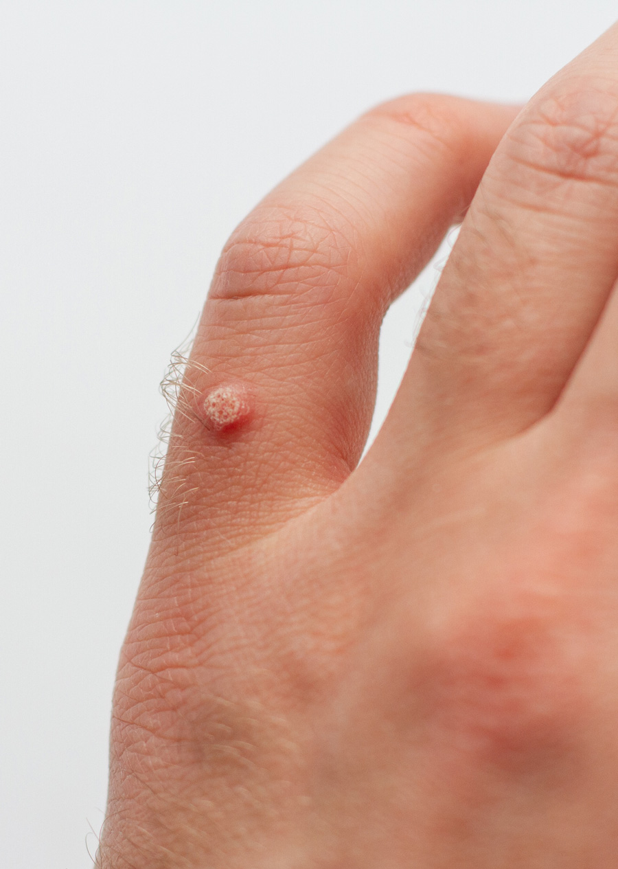 Skin Lesion & Wart Removal - Blemish Clinic Dematology