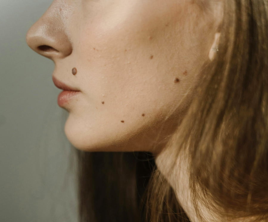 Moles on face