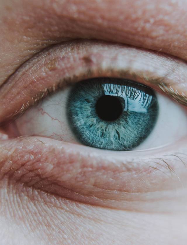 Eye lid and eye bag before undergoing treatment