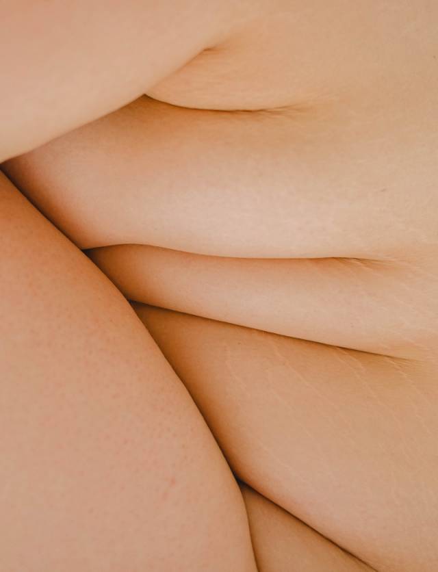 Rolls of fat on woman's body before getting fat dissolving injections.