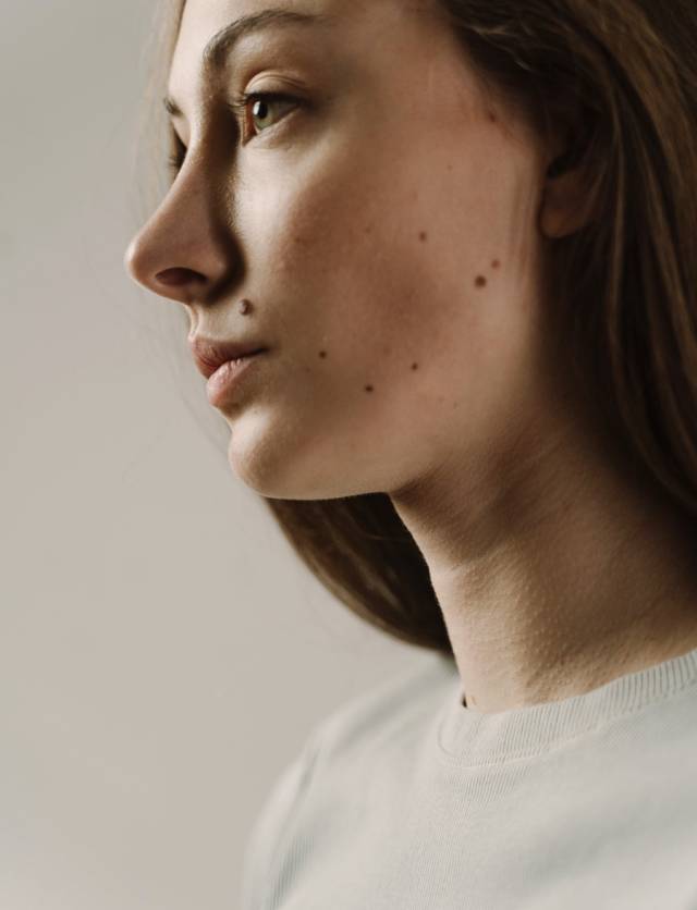 Customer at Blemish Clinic with moles on her face