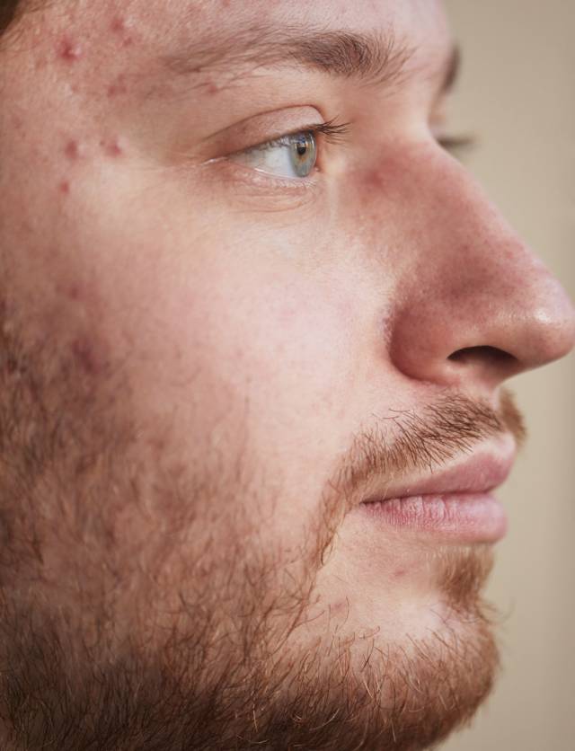 Male with acne on face has Roaccutane treatment in Bury.