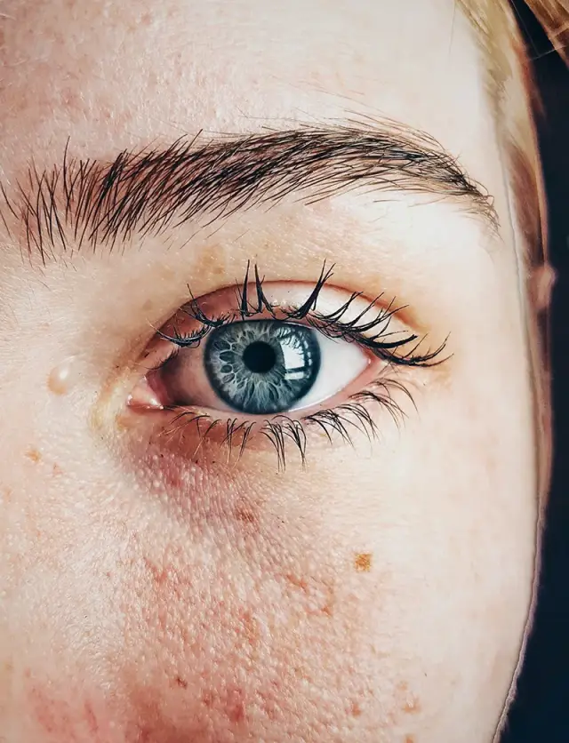 Woman with skin lesion on face, about to get it removed at Blemish Clinic.