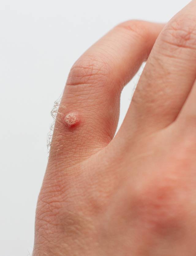 Wart on hand