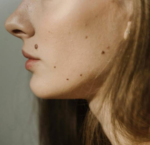 Moles on face