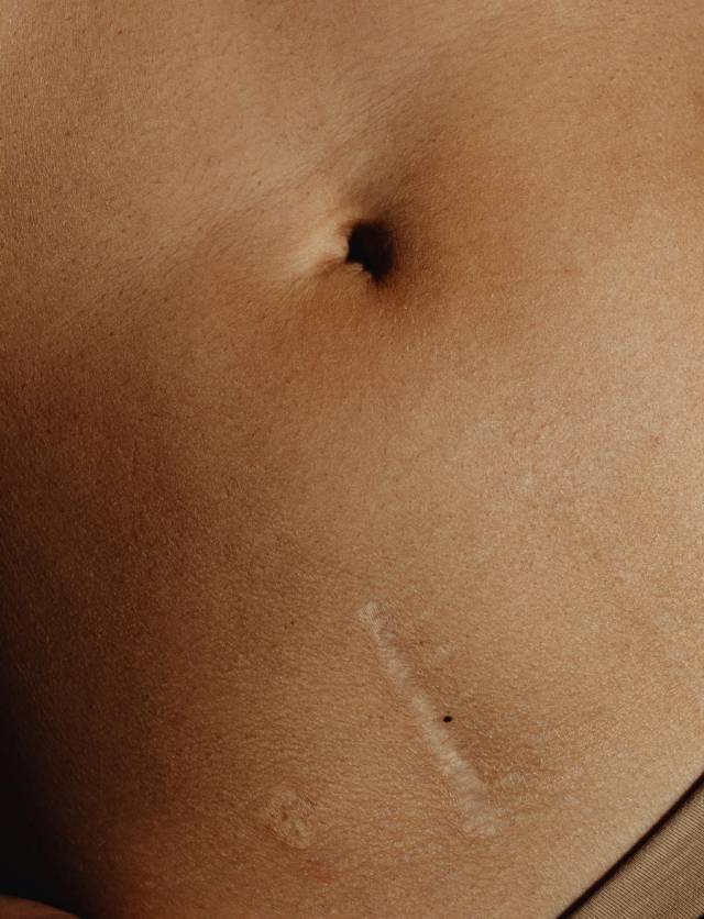 Scar on stomach, about to go under micro-needling treatment