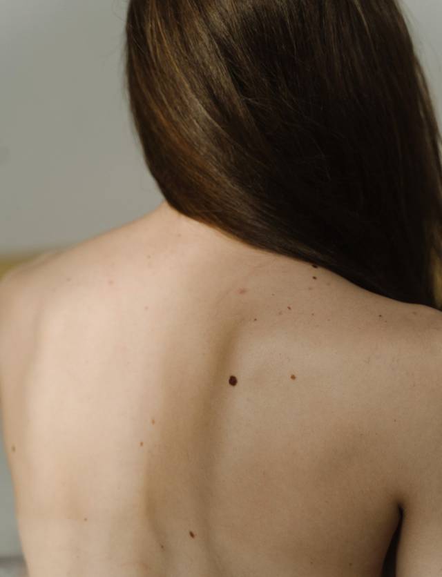 Woman with moles on back. Skin cancer screening in Bury, Lancashire.